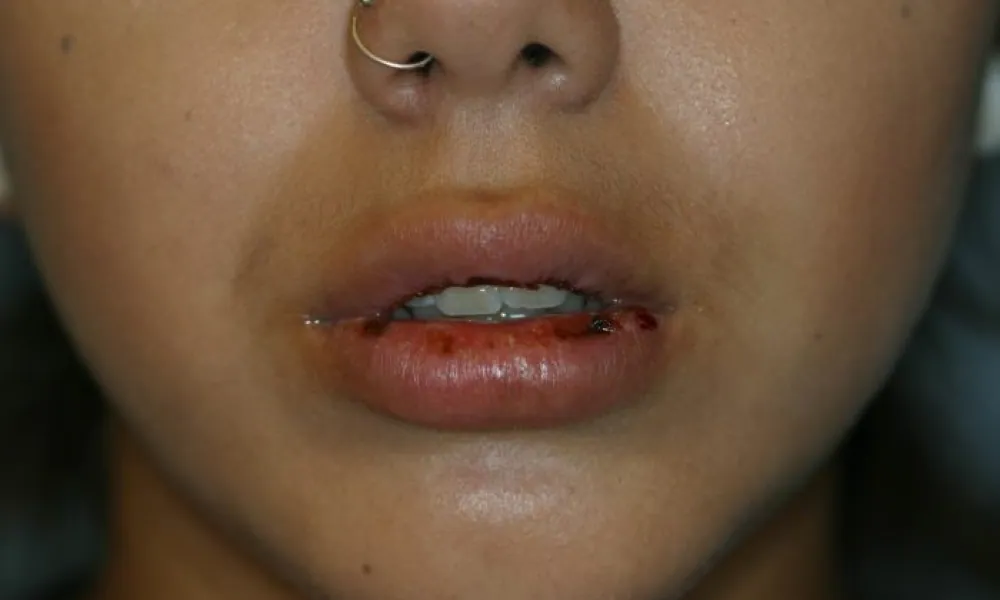 Clinical photo from Alyssa's facial trauma smile makeover case
